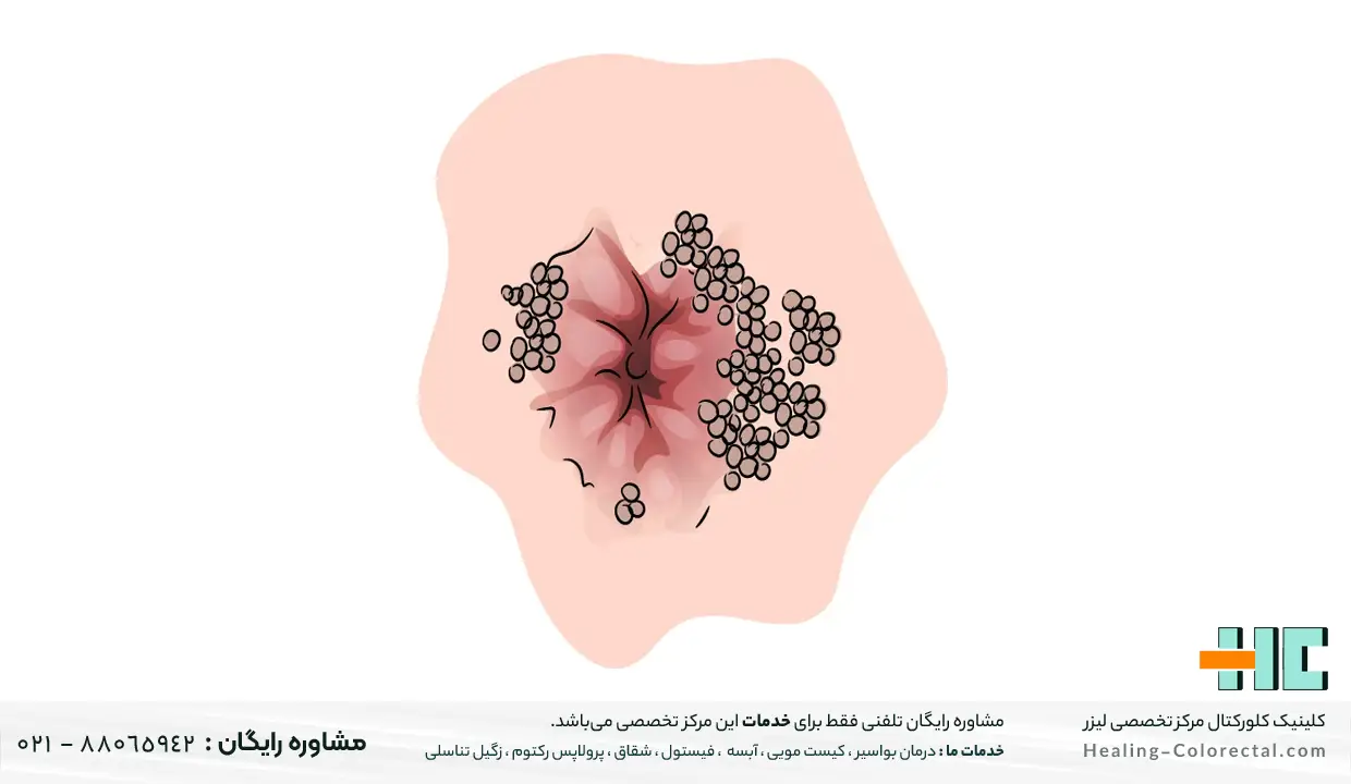 پیشگیری از خارش زگیل مقعدی