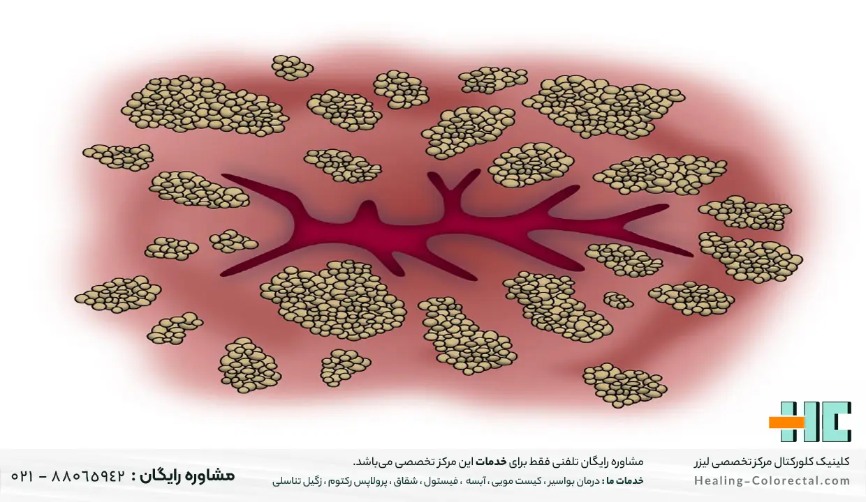 نحوه تشخیص علت خارش مقعدی