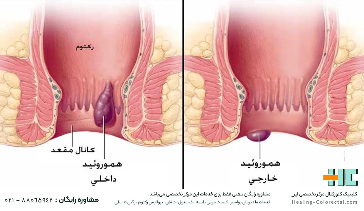 هموروئید ترومبوزه چیست؟