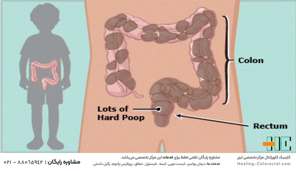 علت هموروئید ترومبوزه