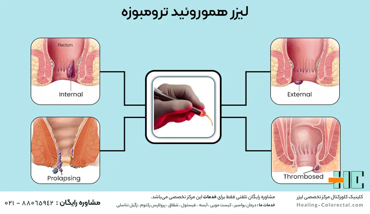 لیزر هموروئید برای درمان ترومبوزه