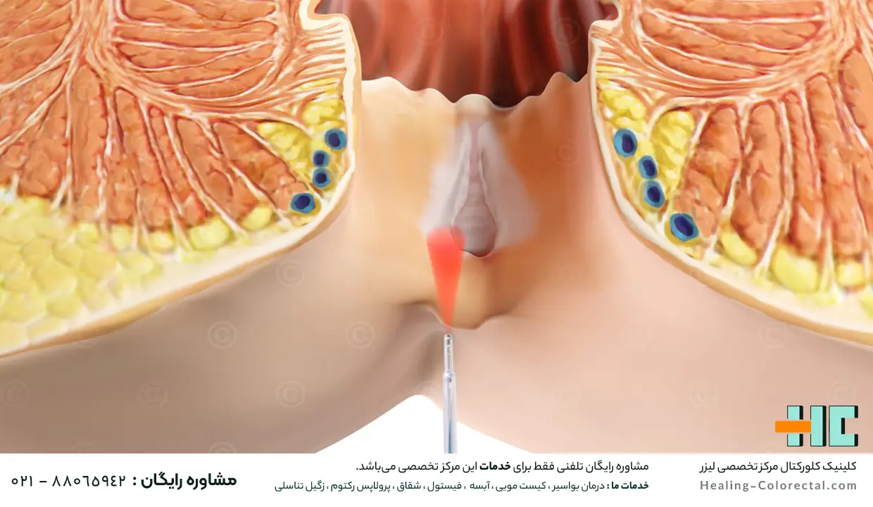 درمان فیشر با لیزر