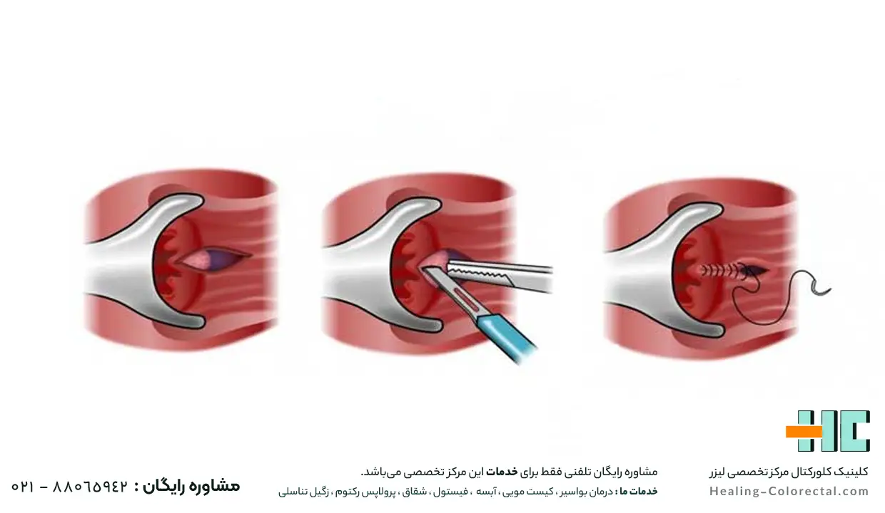 جراحی سنتی شقاق چگونه است