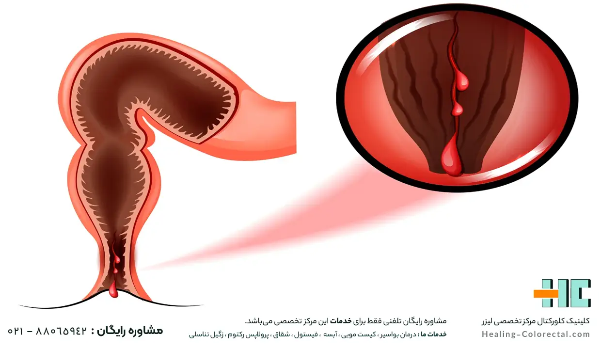 عوارض جراحی سنتی فیشر