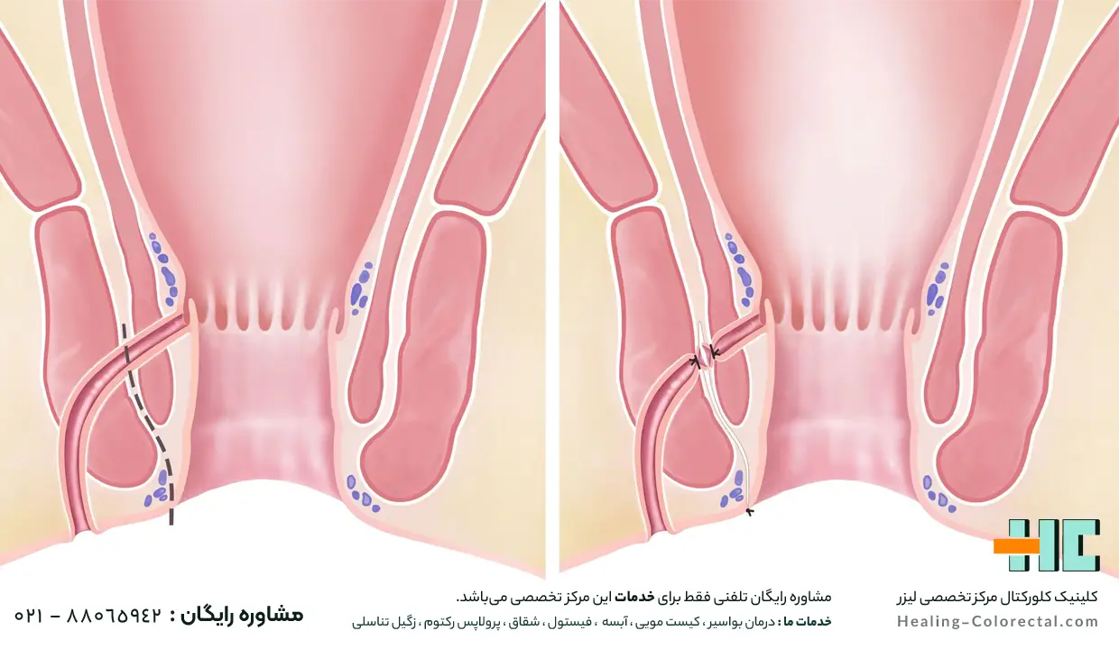 لیزر فیستول مقعدی