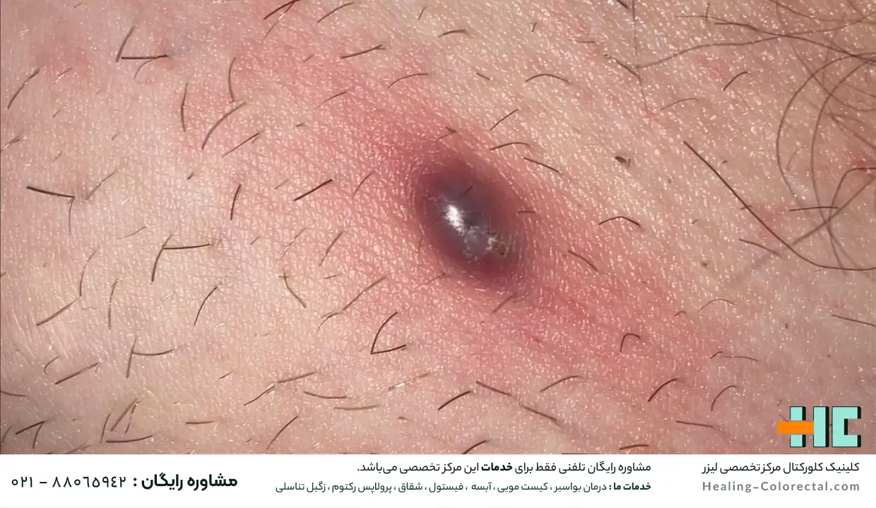 عوارض عمل نکردن کیست مویی