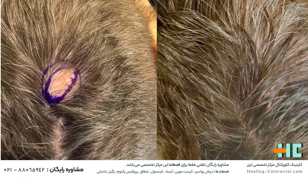 آیا عمل نکردن کیست مویی باعث تشدید می‌ شود؟