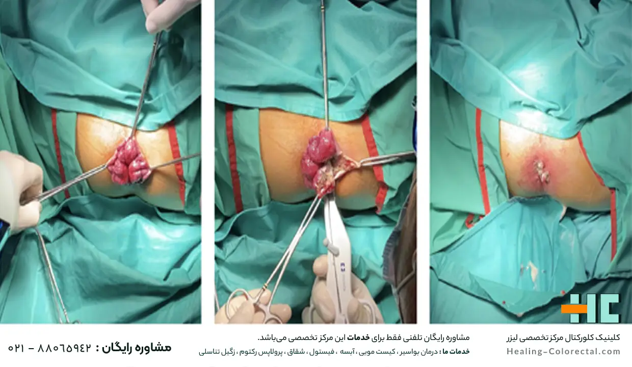 جراحی بواسیر در زنان