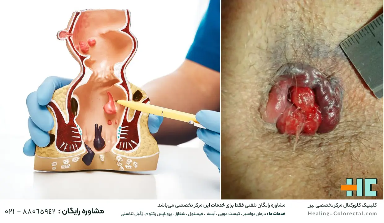 عکس بواسیر در زنان