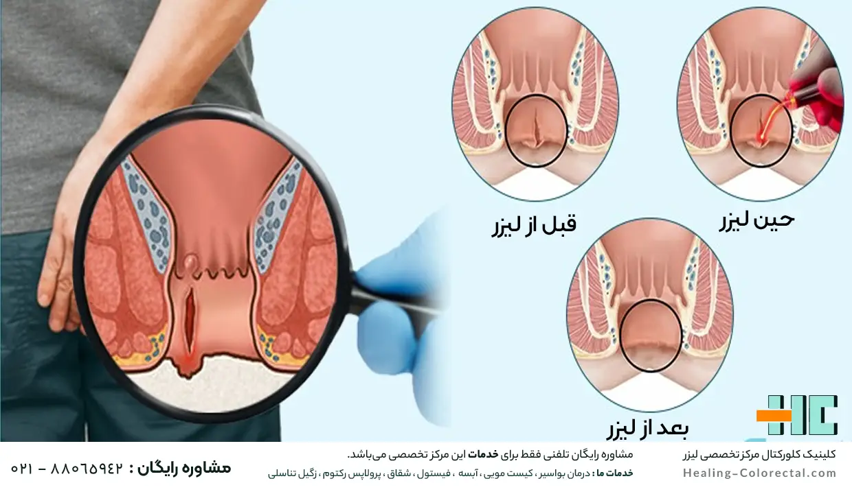 قبل حین و بعد از لیزر شقاق