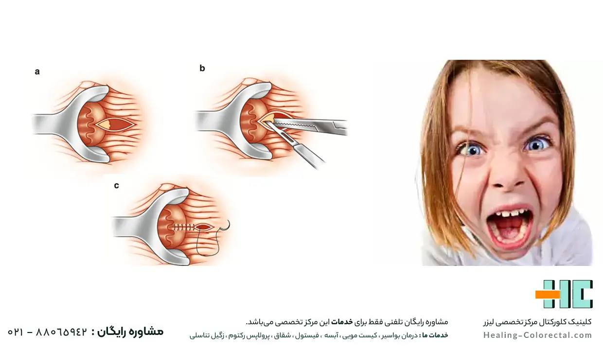 کاهش درد از مزیت لیزر شقاق است