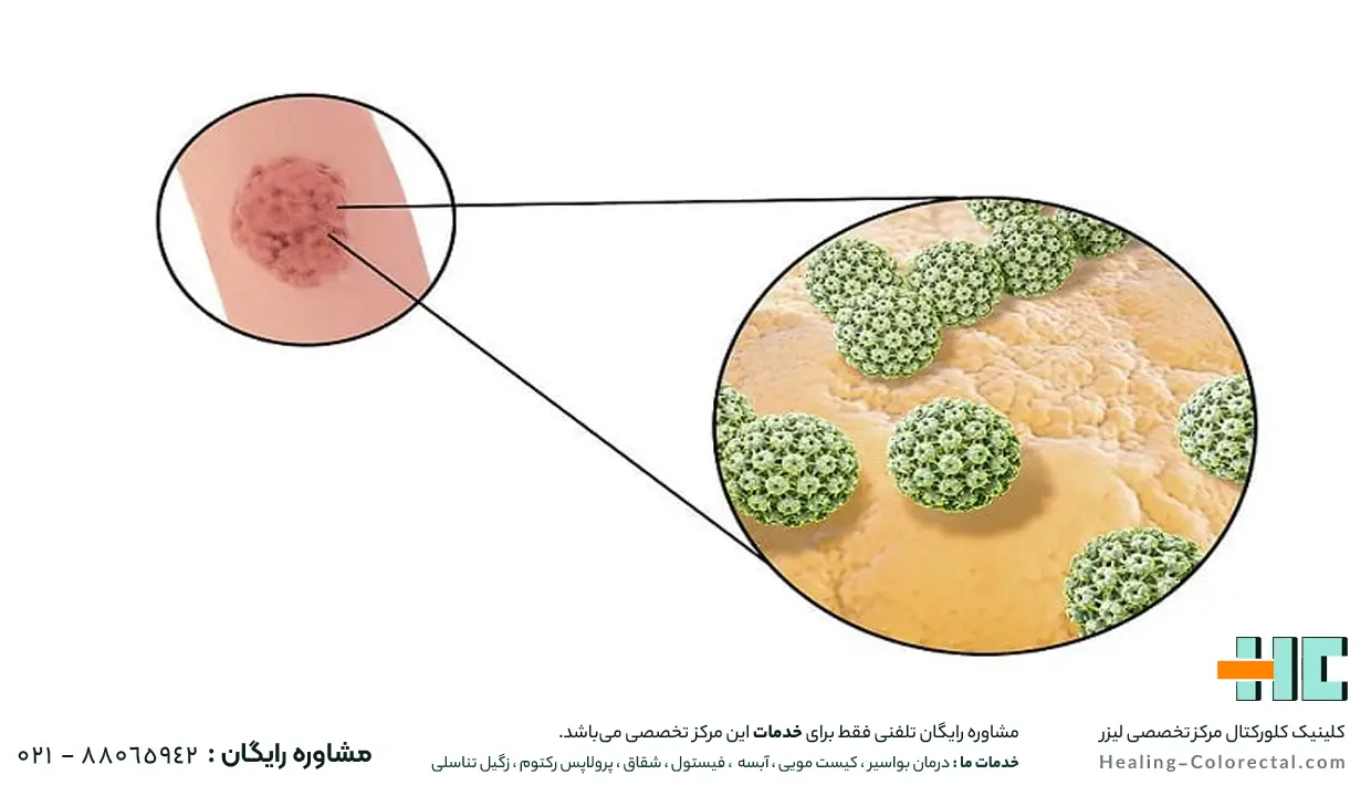 همه چیز درمورد زگیل تناسلی
