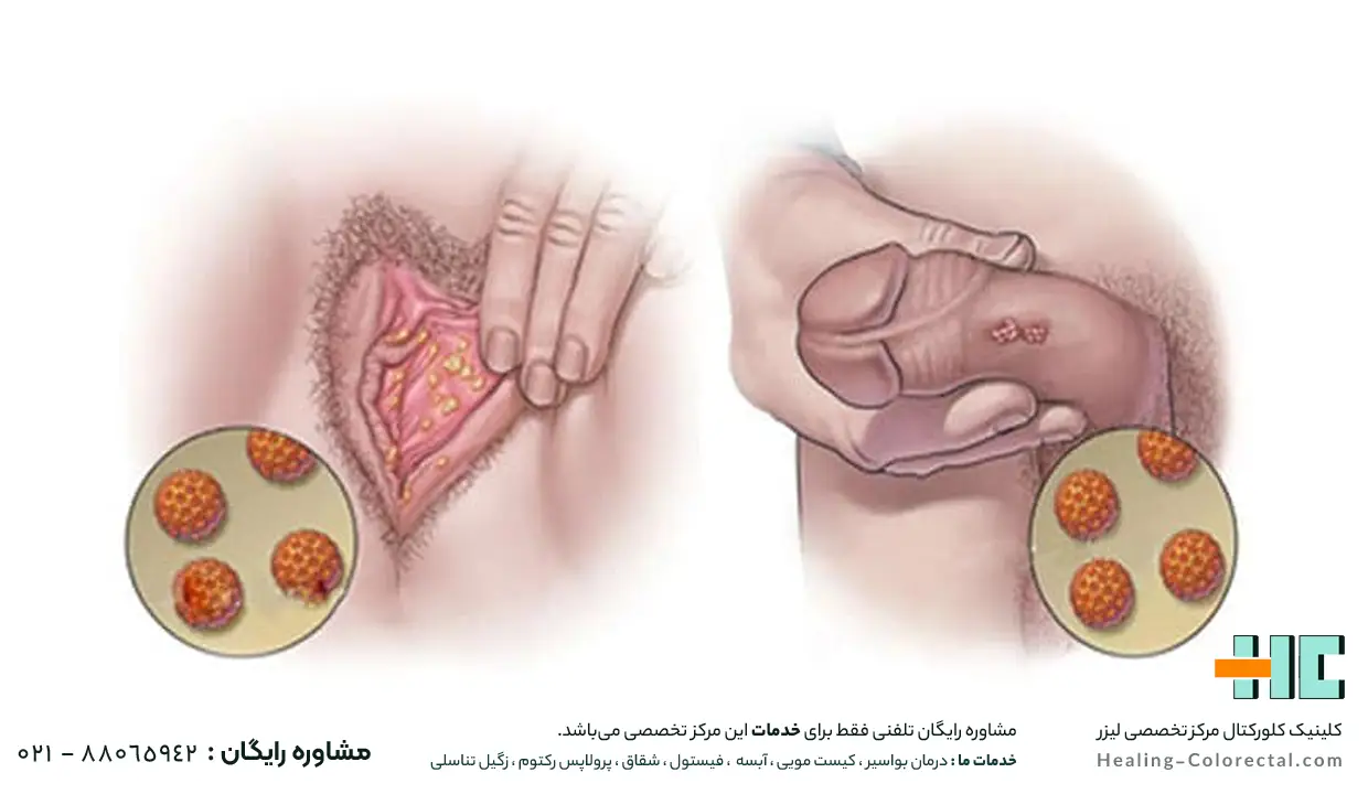 زگیل تناسلی در چه نواحی ایجاد می شود؟