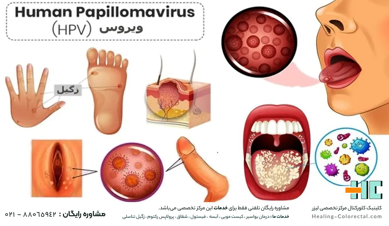 همه چیز راجب زگیل تناسلی