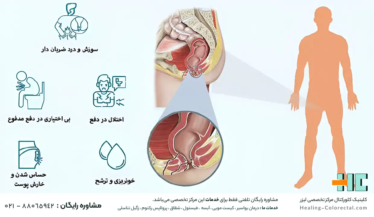 نشانه‌ها و علائم فیستول