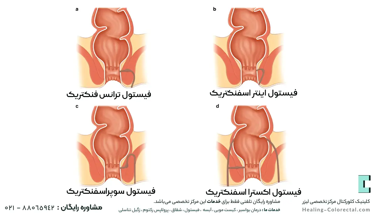 انواع فیستول