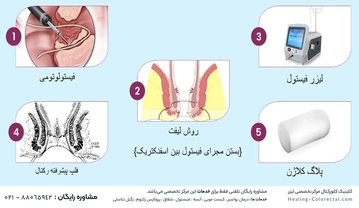 انواع درمان فیستول مقعدی