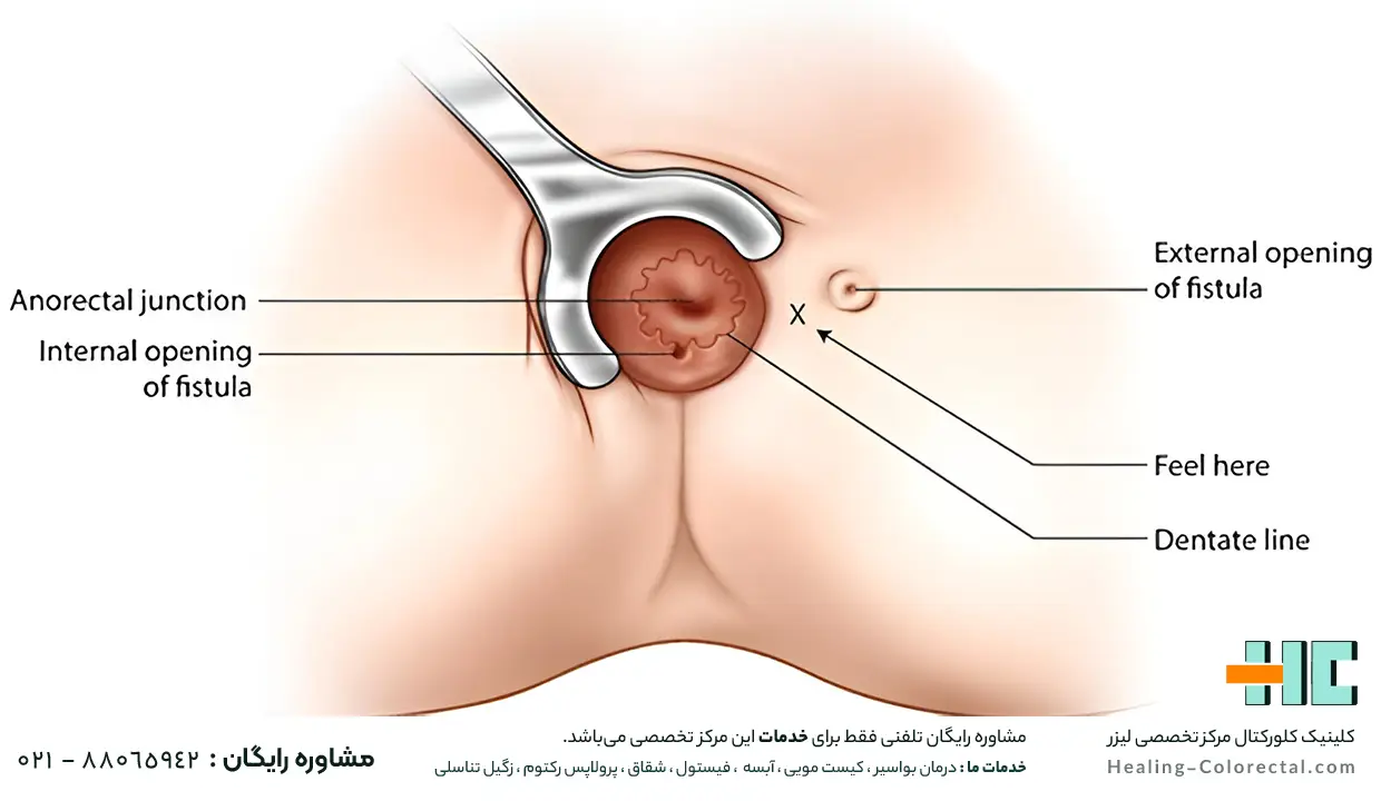 عمل جراحی فیستول مقعدی