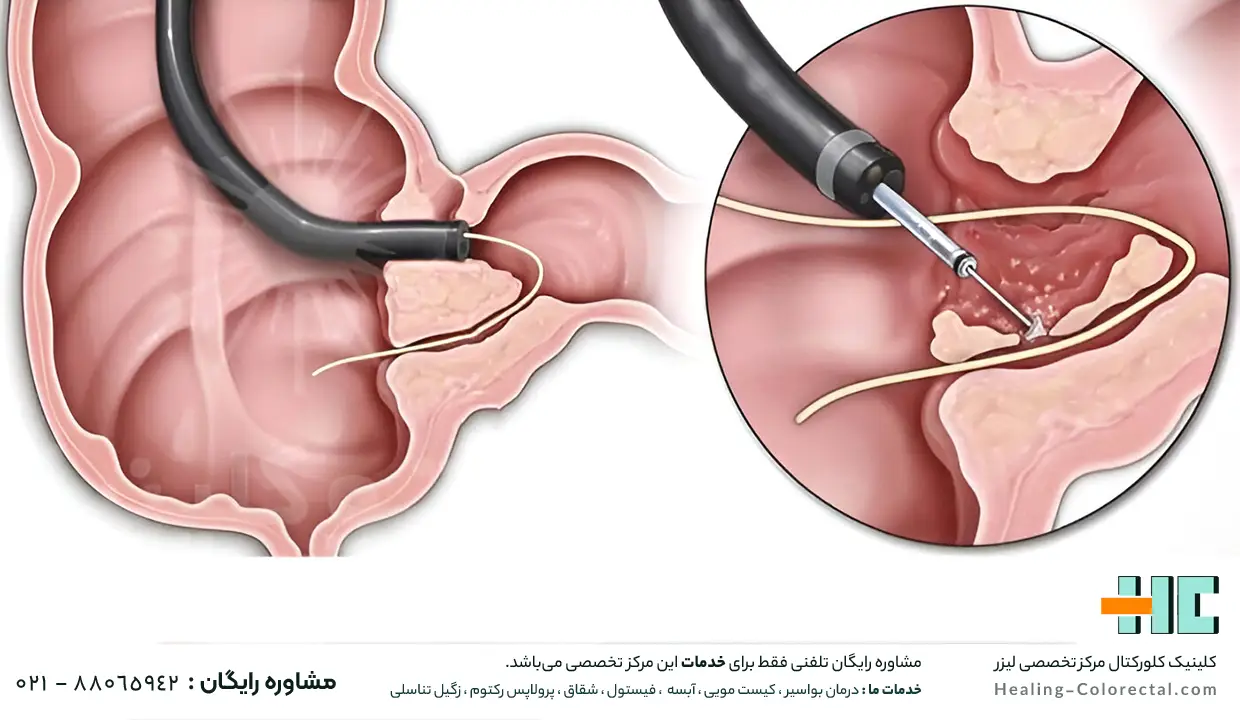 لیزر فیستول مقعدی