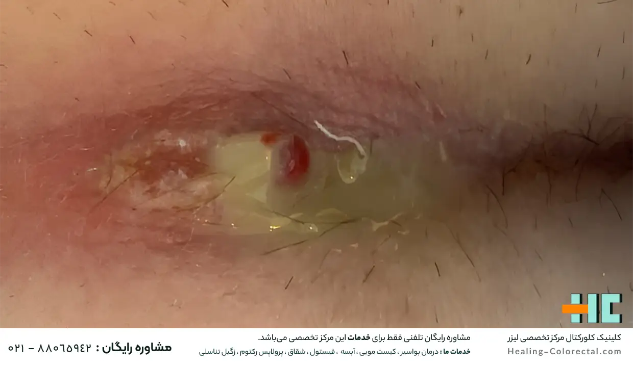کیست پیلونیدال اگر درمان نشود