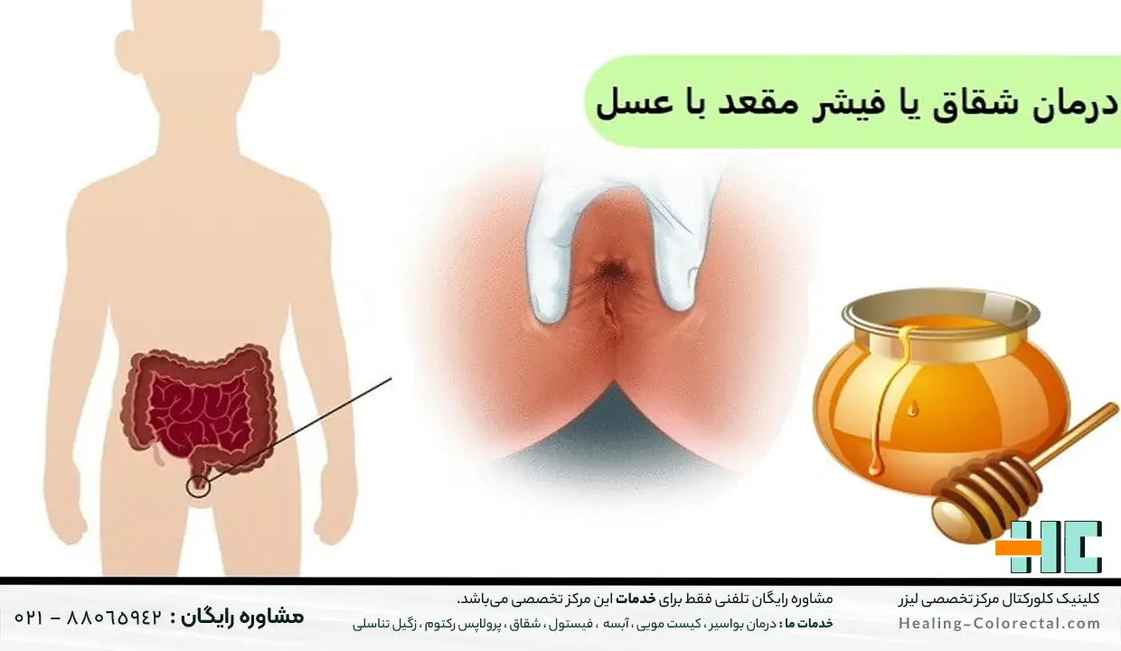 عسل مانوکا برای درمان فیستول مقعدی در طب سنتی