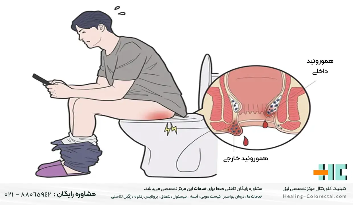 علائم بواسیر در مردان
