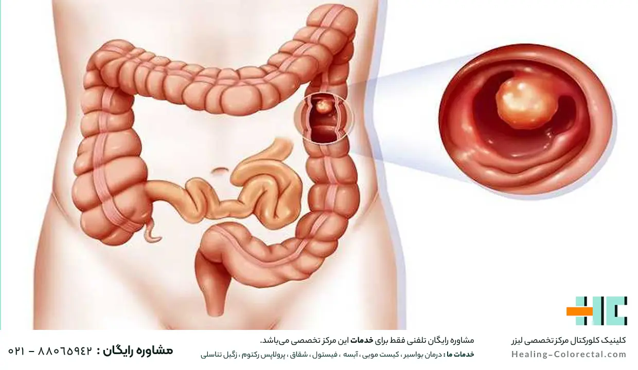 عوامل ایجاد کننده سرطان رکتوم