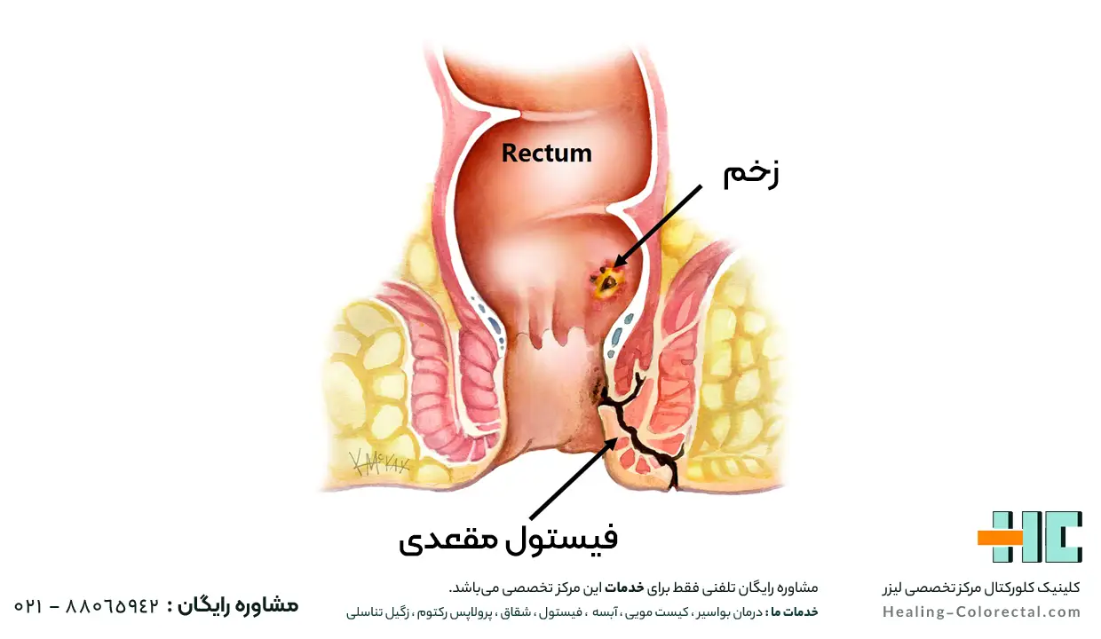 مدت زمان انجام جراحی آبسه مقعدی با لیزر