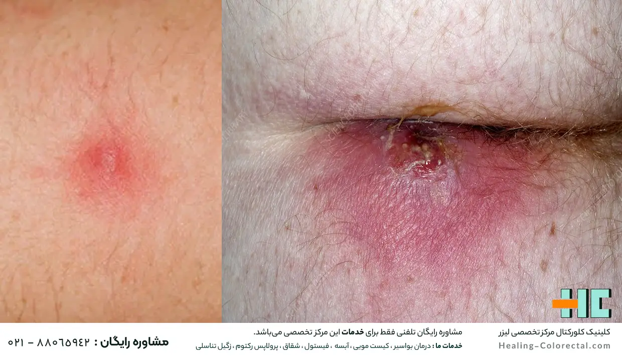 هزینه درمان آبسه مقعدی با لیزر 
