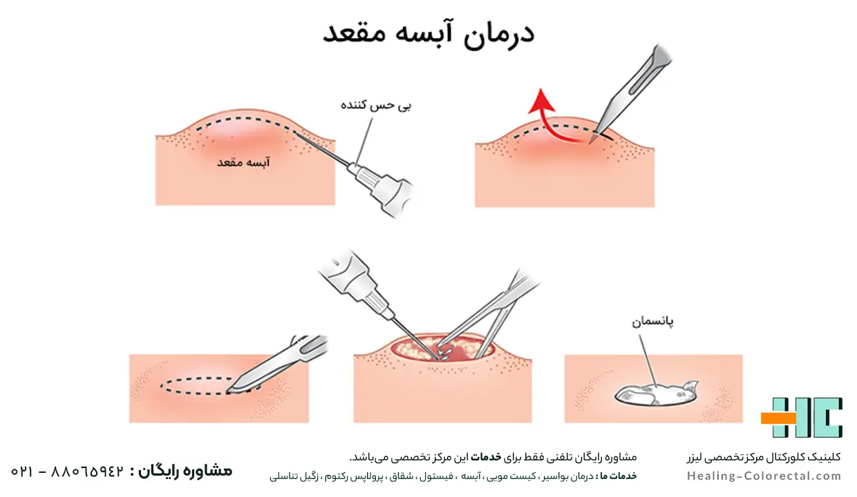 مزایای لیزر آبسه مقعدی 