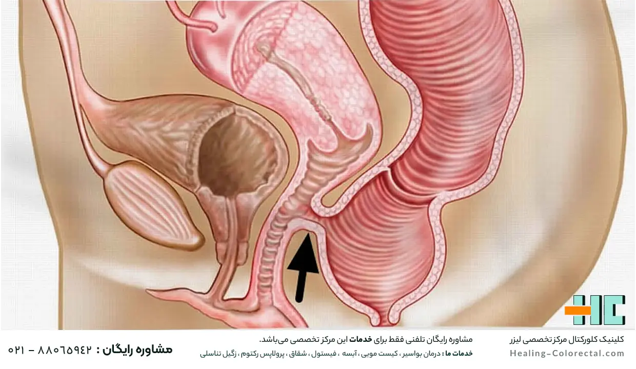 تشخیص فیستول واژن