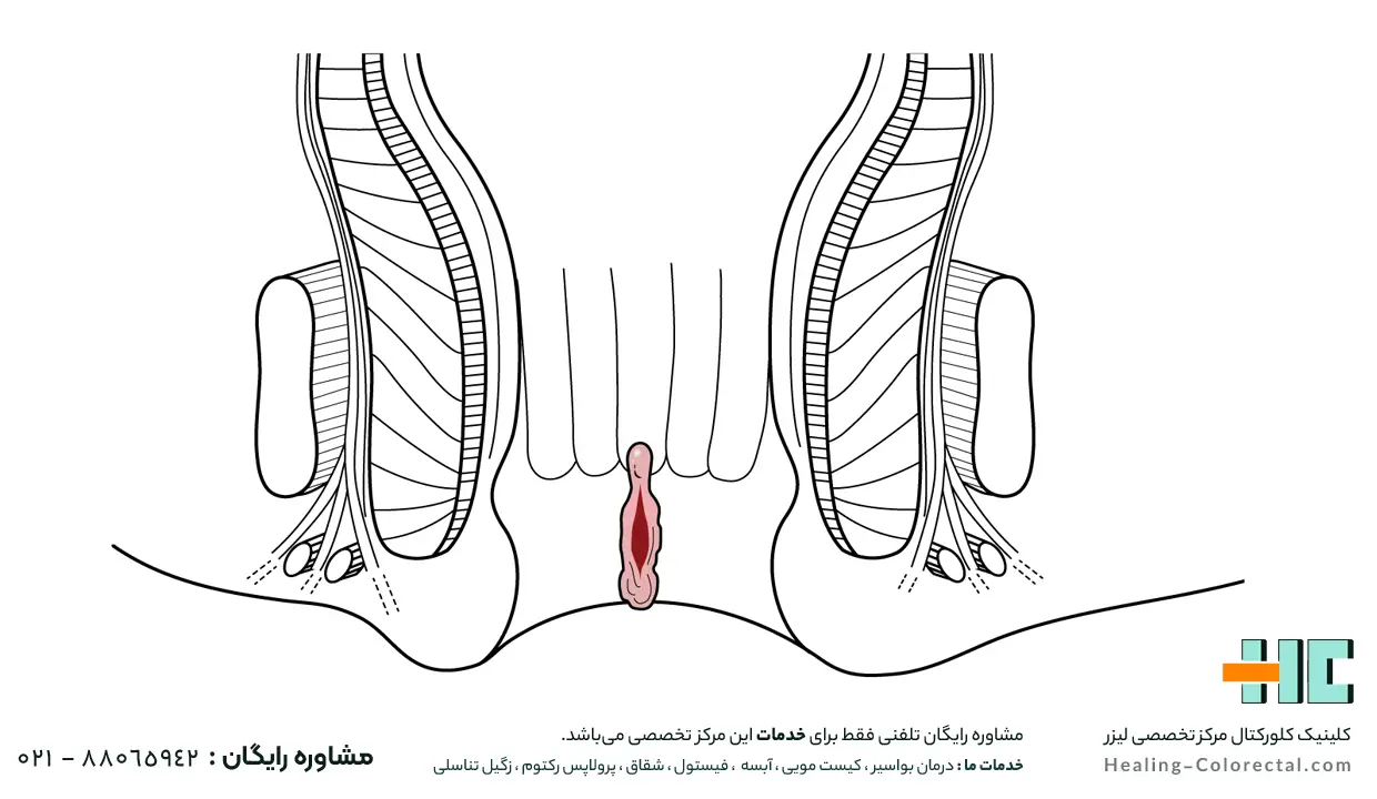 شقاق مقعدی چیست