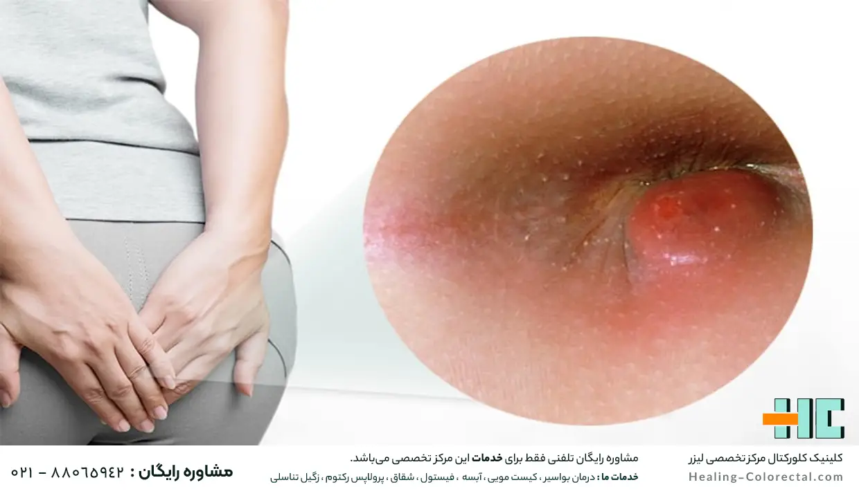 علائم فیشر یا شقاق مقعدی