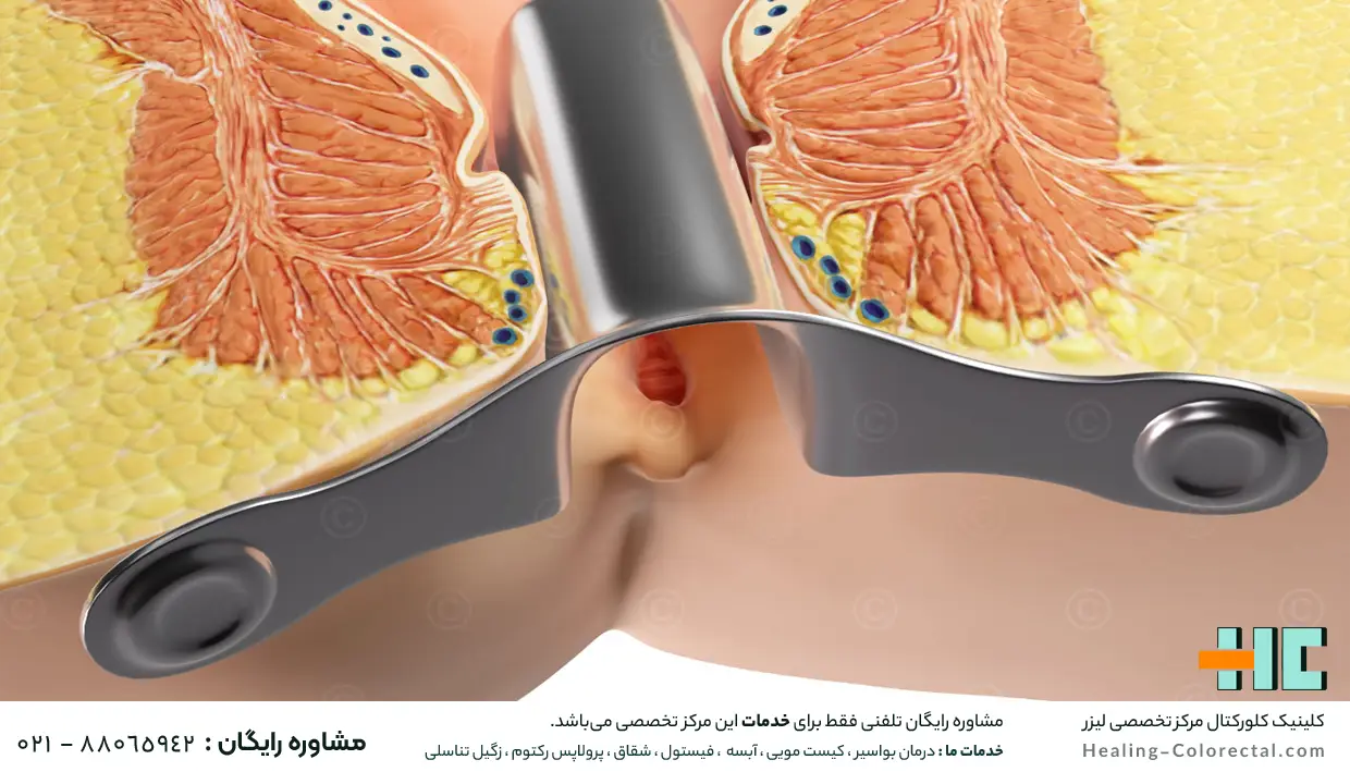 بهترین درمان شقاق مقعدی