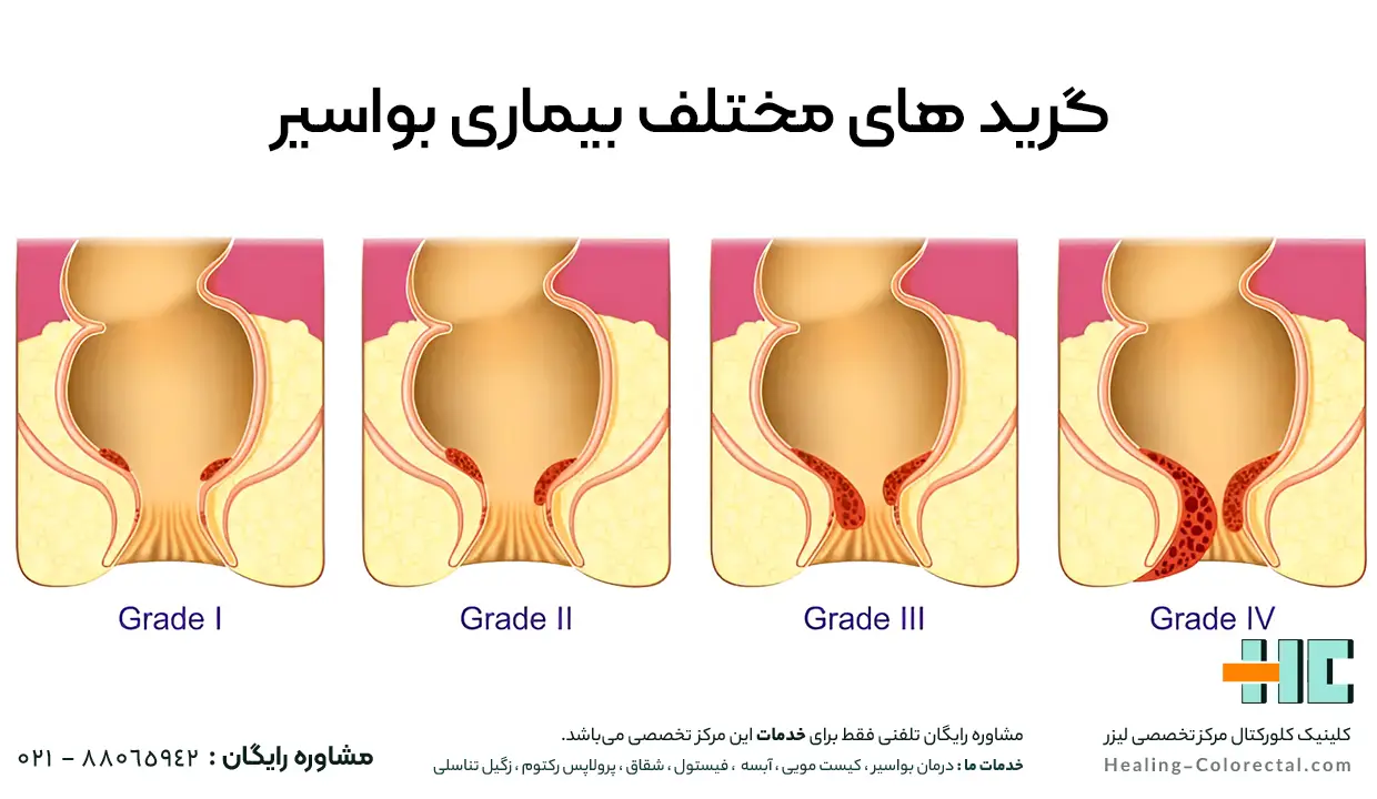 انواع هموروئید یا بواسیر چیست