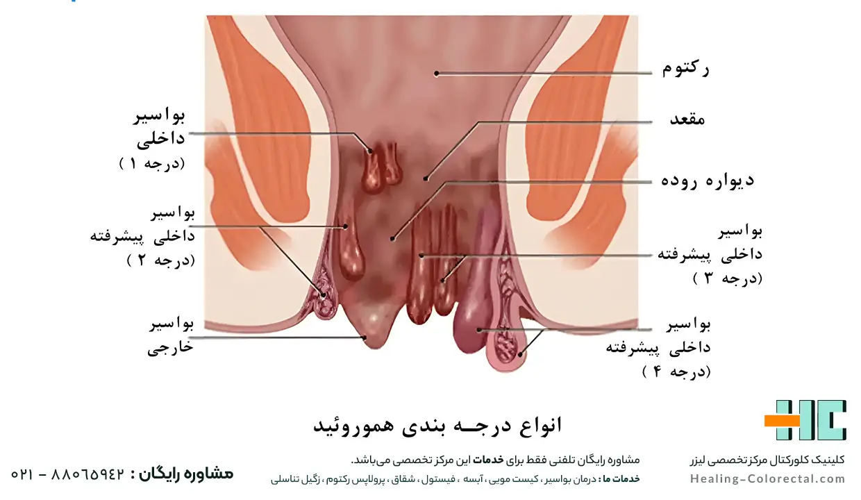 هموروئید یا بواسیر داخلی