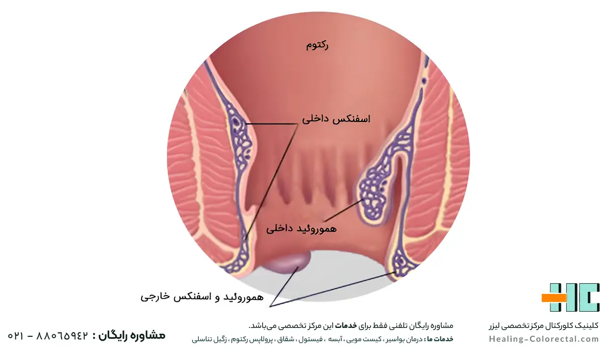 هموروئید یا بواسیر خارجی