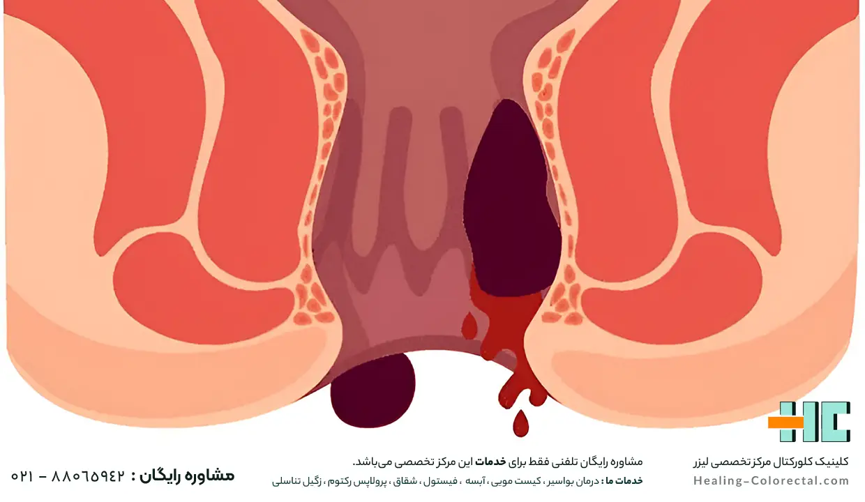 نشانه ها و علائم هموروئید
