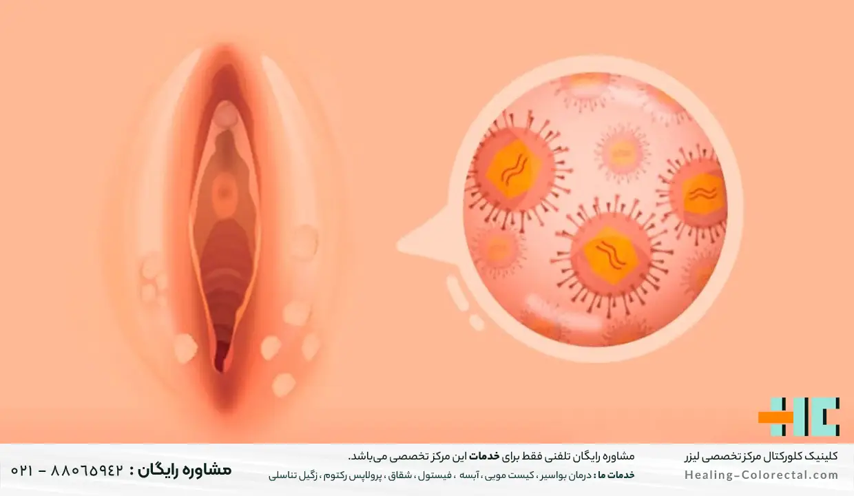 زگیل تناسلی