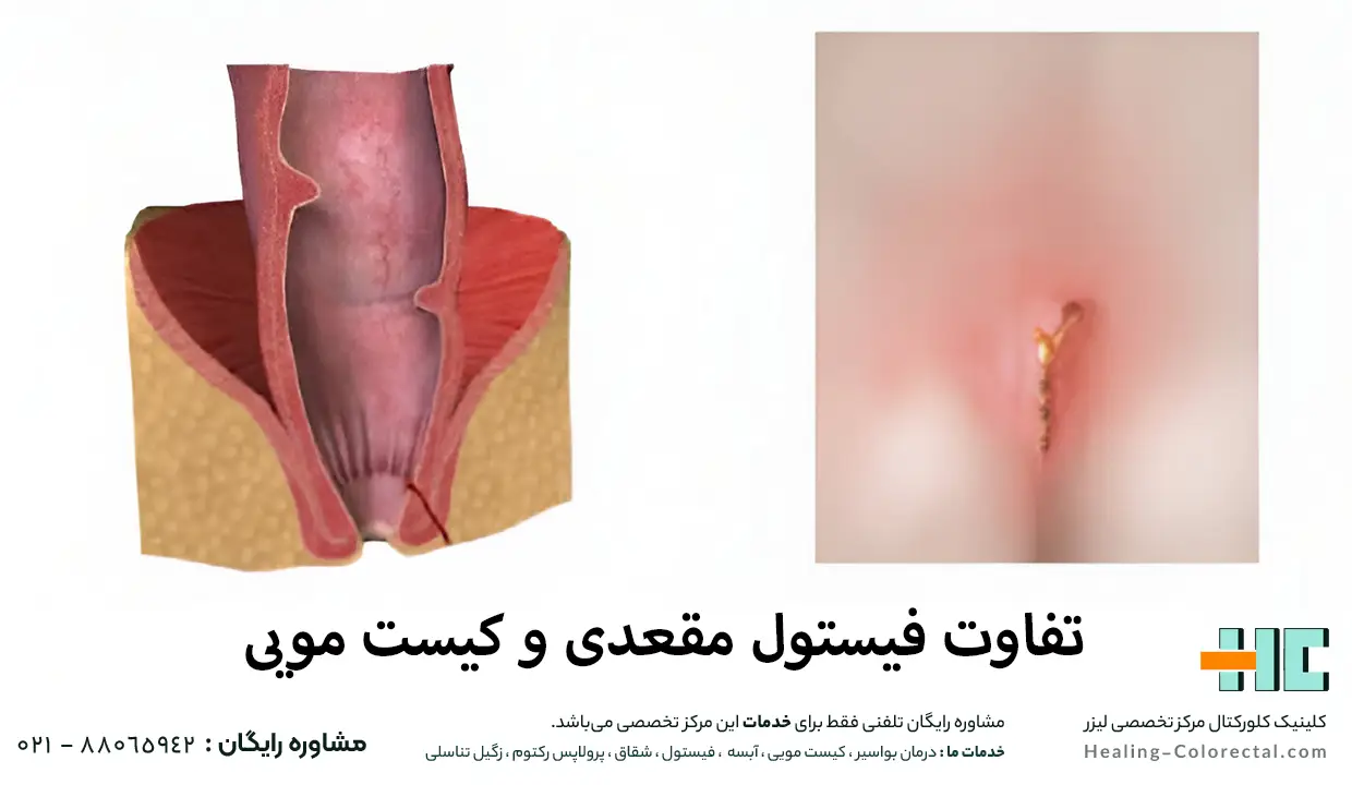 تفاوت فیستول مقعدی و کیست مویی 