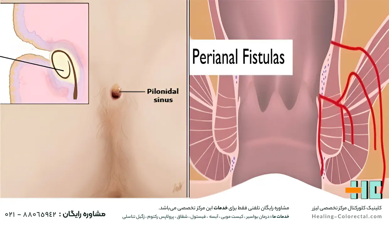 شباهت فیستول مقعدی و کیست مویی 