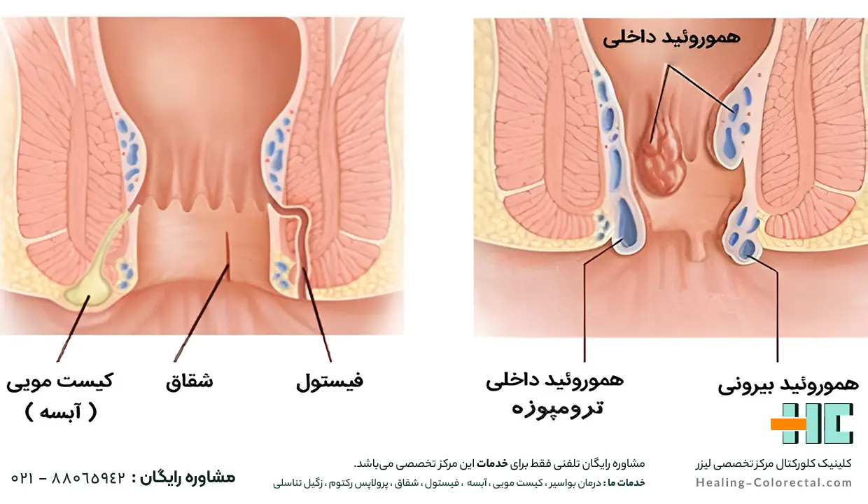 تفاوت شکل فیستول مقعدی و کیست مویی