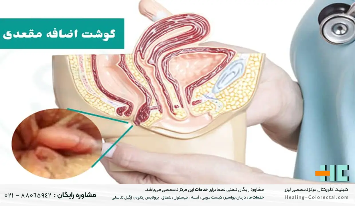 درمان گوشت اضافه مقعدی با لیزر