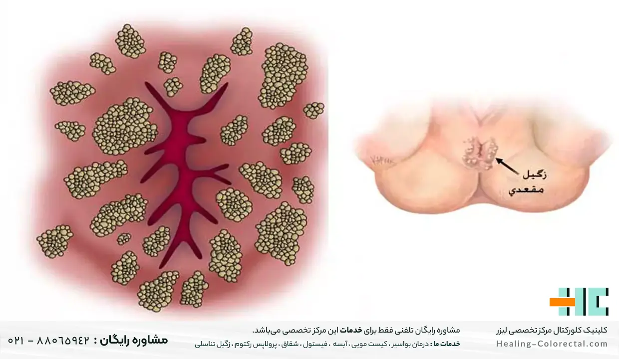 بهترین پماد درمان زگیل مقعدی