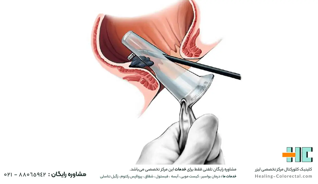 درمان بواسیر با لیزر