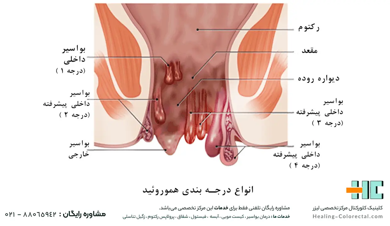 بواسیر داخلی چیست؟