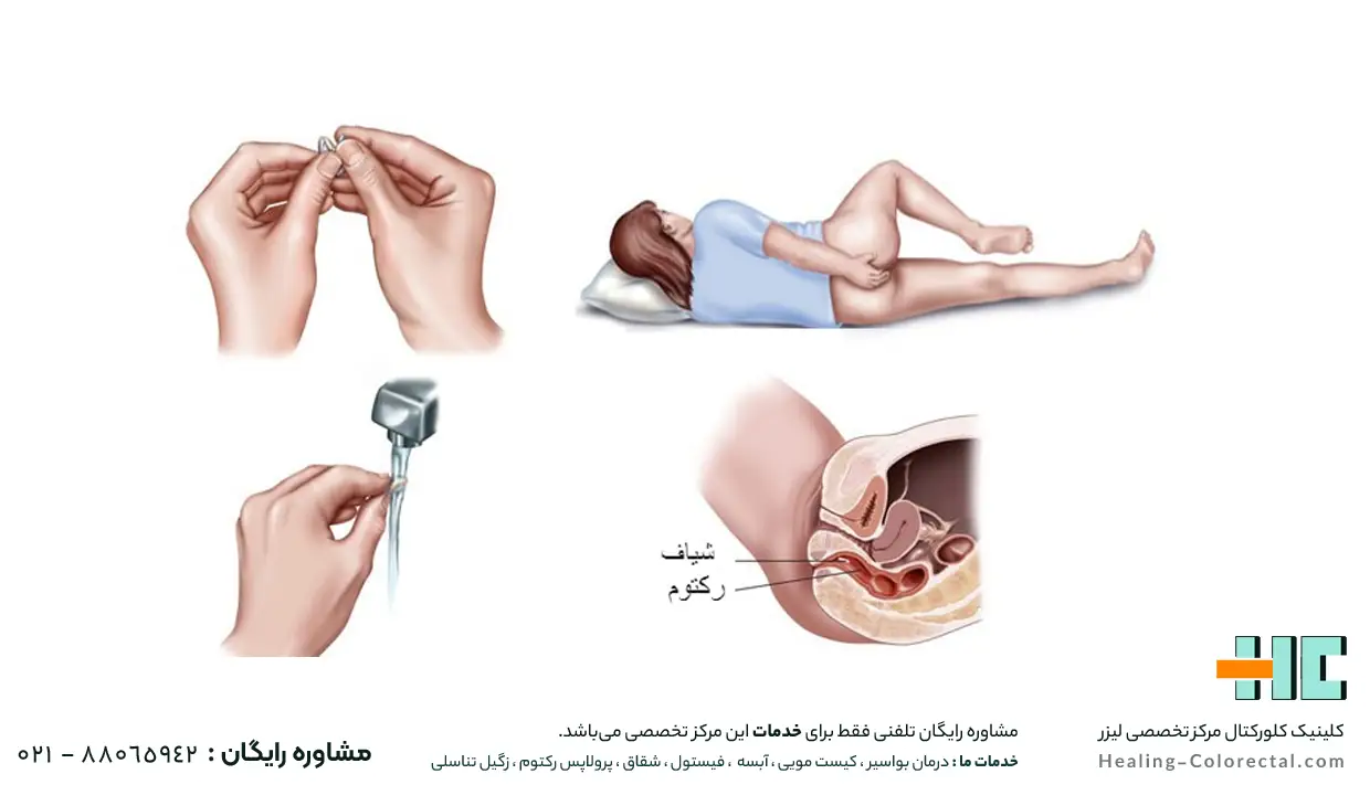 انواع درمان بواسیر داخلی 