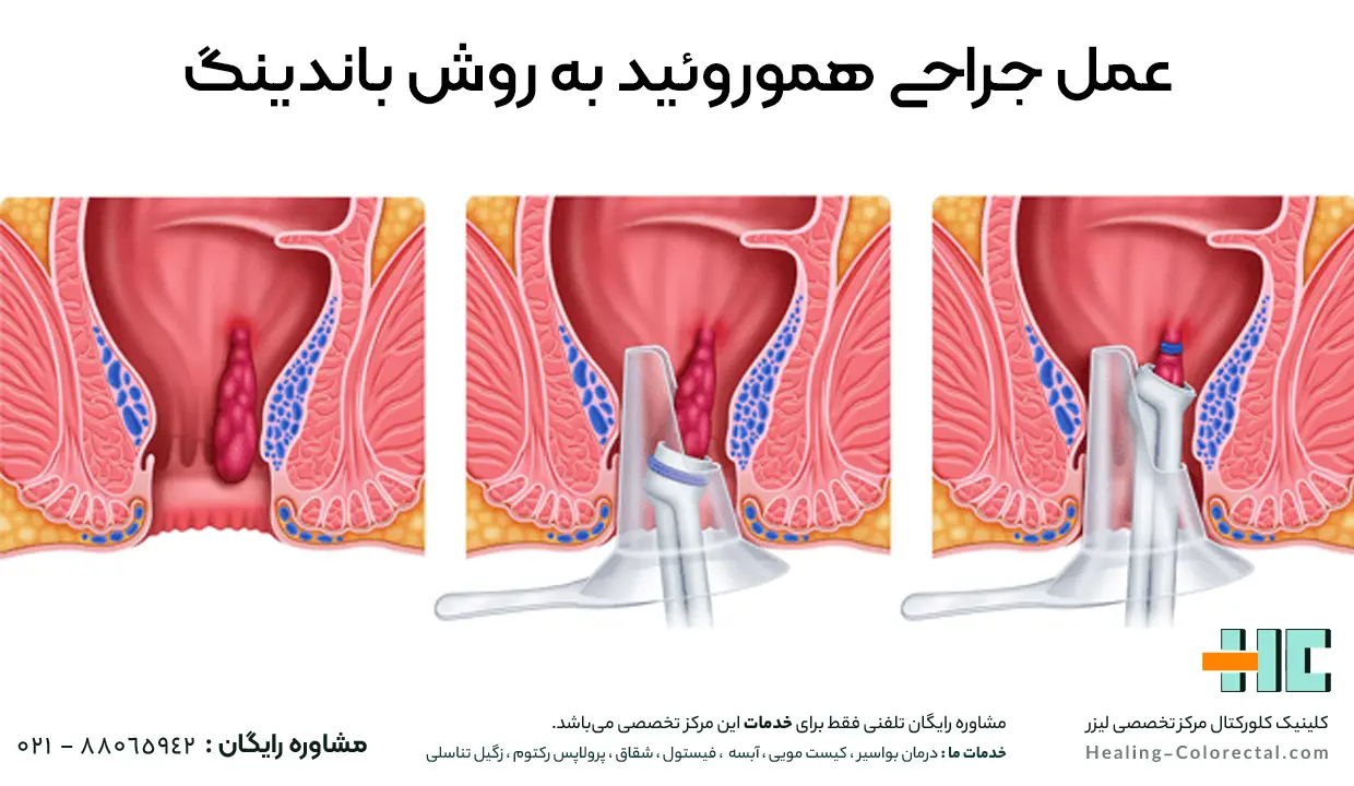عمل جراحی هموروئید به روش باندینگ