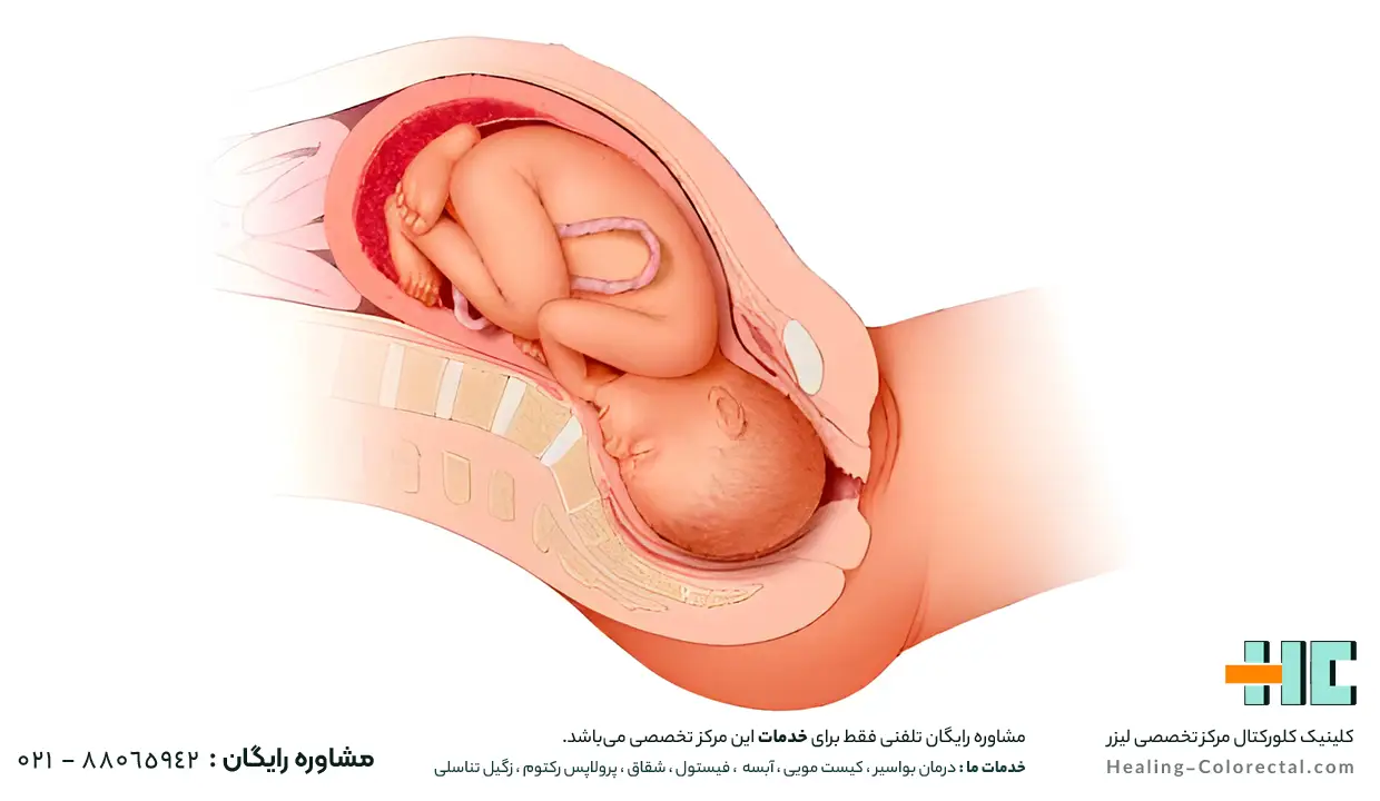 چرا بواسیر در بارداری تشدید می‌ شود؟ 