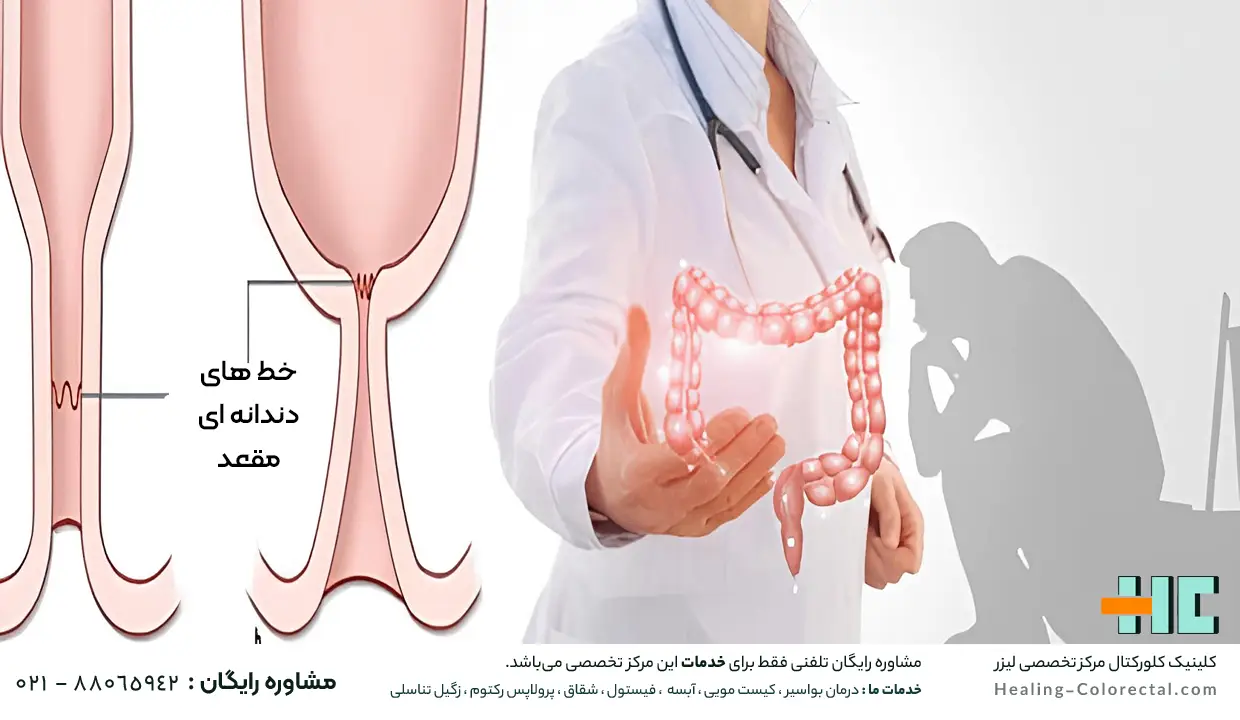 علت تنگی مقعدی چیست
